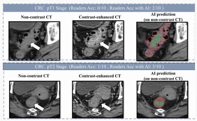 阿里巴巴发布创新癌症AI模型 助力肠癌筛查阿里巴巴达摩院在医疗领域再度发力，近期联合广东省人民医院等机构，成功研发出一种新的肠癌筛查 AI 模型 ——DAMO COCA